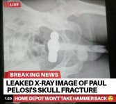 paul-pelosi-x-ray-v0-j23r53u0b0x91.jpg